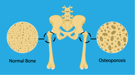 Illustration of normal bone structure compared to an osteoporotic bone.